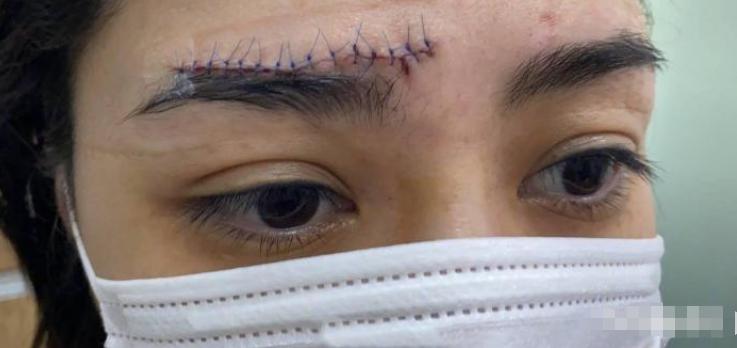 阿娇伤后首露面图片,阿娇晒出额头受伤照片