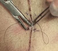 常用的手术缝合方法图,临床常见常用伤口缝合方法