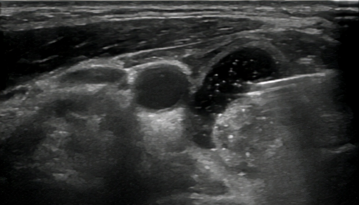 甲状腺结节微波消融术,厦门有微波消融术治疗甲状腺结节