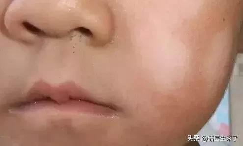 治疗儿童皮肤病的外用药,儿童皮肤病有哪些偏方