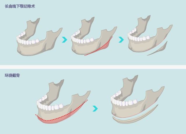 磨骨手术属于几级手术,揭秘神秘的手术室