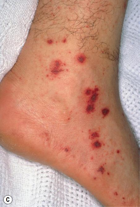 过敏性紫癜算是风湿病的一种吗,风湿性关节炎与过敏性紫癜区别