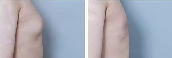 9岁小男孩吃炸鸡,男子吃炸鸡导致胸部发育