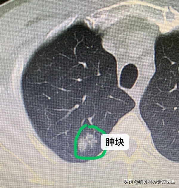 陈大哥咳嗽发现肺部肿块，坚持要手术切除，却是隐球菌感染