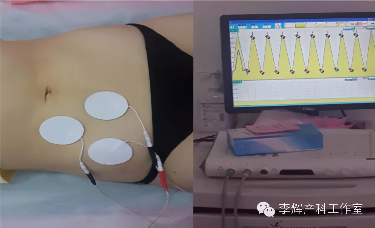 产后42天做盆底康复检查有必要吗,产后42天盆底康复做哪些检查