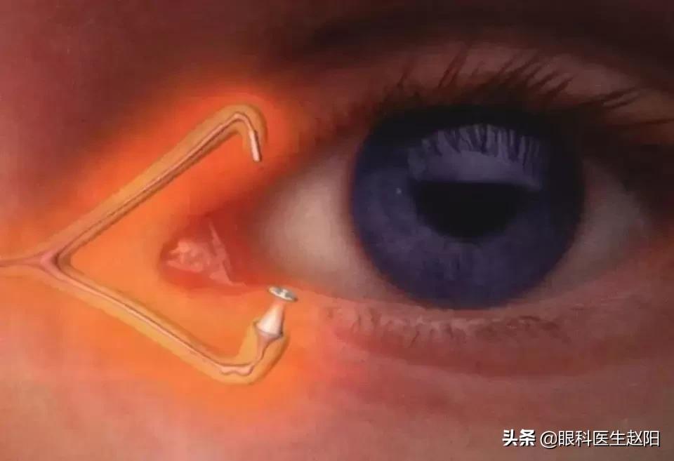 缓解干眼症的眼药水有哪些,缓解干眼无防腐剂眼药水