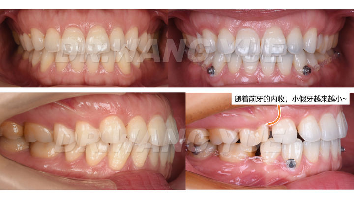 上海口腔医院牙齿矫正牙缝,上海牙齿畸形龅牙矫正