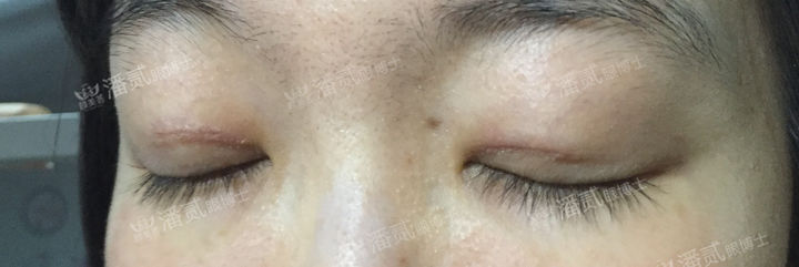 原来双眼皮不好看有必要继续割吗,割双眼皮是不是越修复越难看