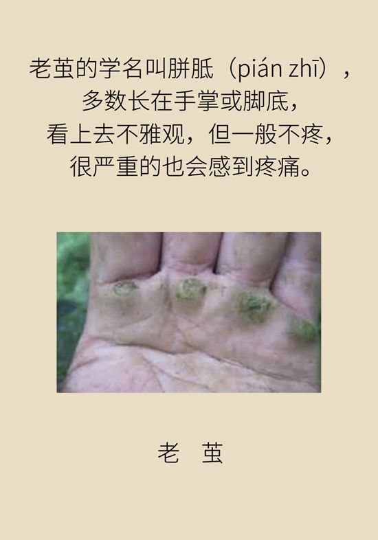 长了鸡眼该怎么办四大妙招教给你,长了鸡眼怎么治疗好得快