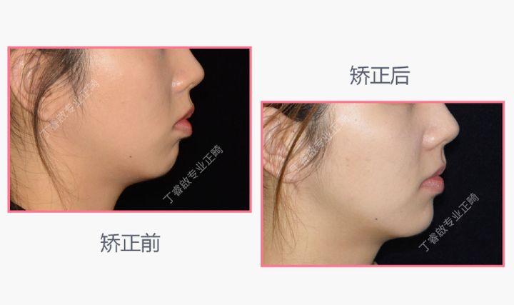 单颗牙隐形矫正,郑州隐形矫正牙齿哪家便宜