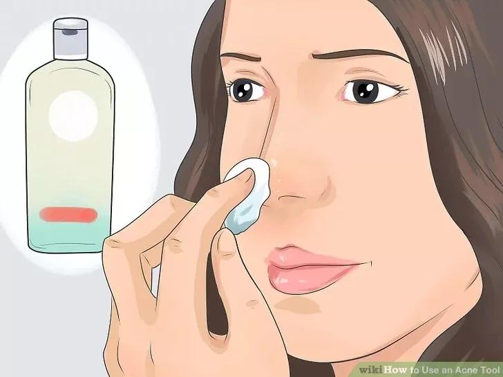 针清祛痘一般多少钱一次,针清祛痘后可以涂甲硝唑吗