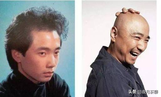 发际线太高怎么办一招解决,我发际线秃了怎么办