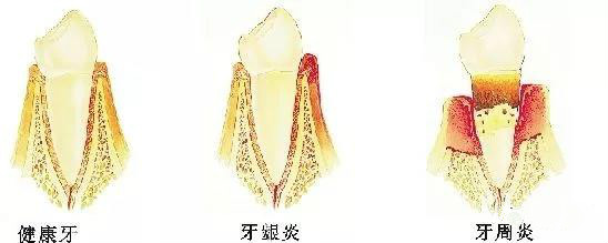 牙齿矫正有4个误区,牙齿矫正的副作用知多少