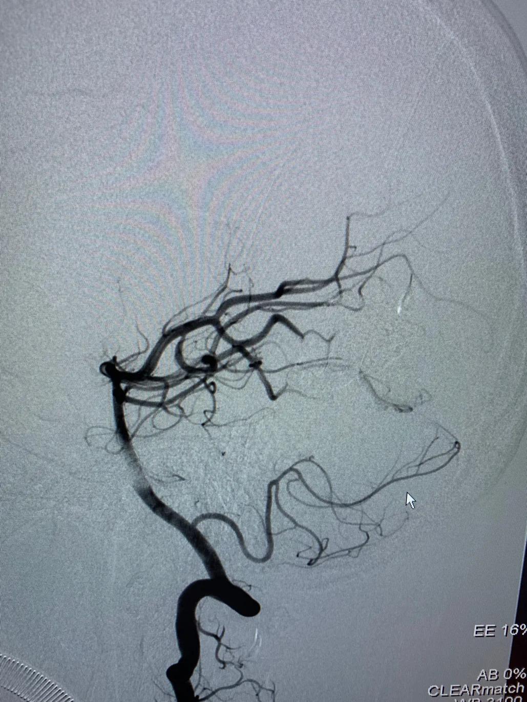 脑动静脉畸形介入栓塞手术的风险,介入栓塞技术在脑avm治疗中的作用