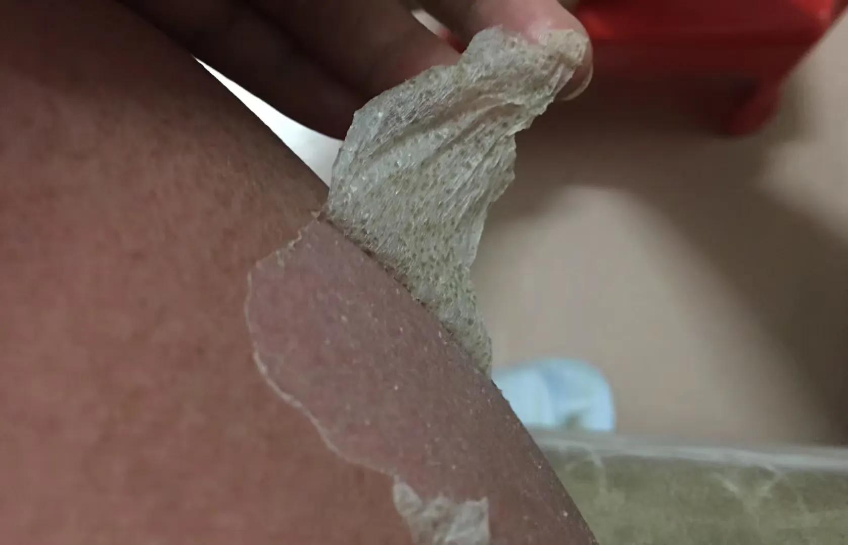 骨折人情冷暖,骨折后明白了人间冷暖