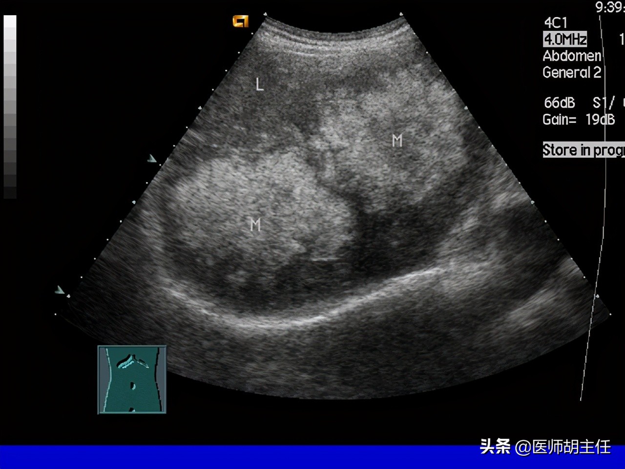 检查肝脏是b超好还是ct好,做肝脏彩超跟ct哪个贵