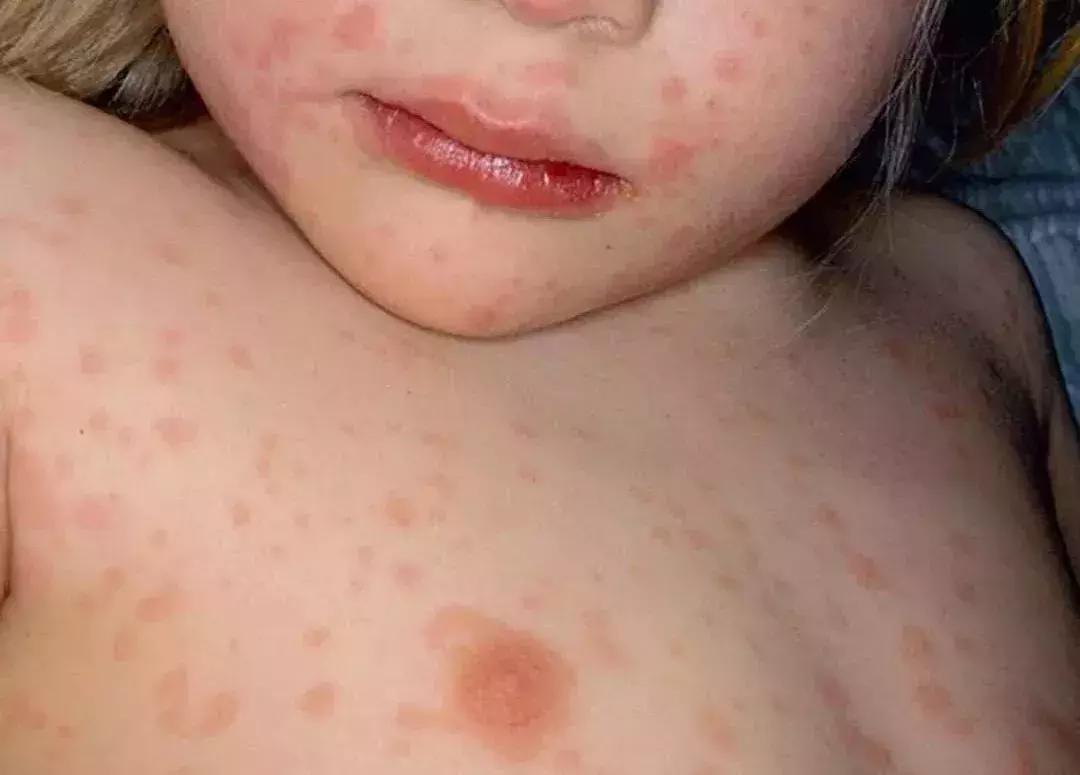 看图说病！专家提醒：立春后娃最易感染6种疹子，一定要认准了治
