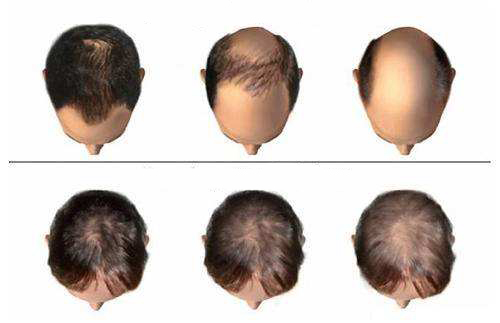 脂溢性脱发能治好吗知乎,脂溢性脱发能治好吗怎么治疗