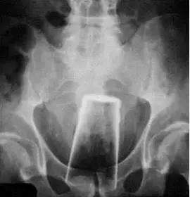 女孩子把异物放在身体里后果,把异物塞进肚子里会怎样