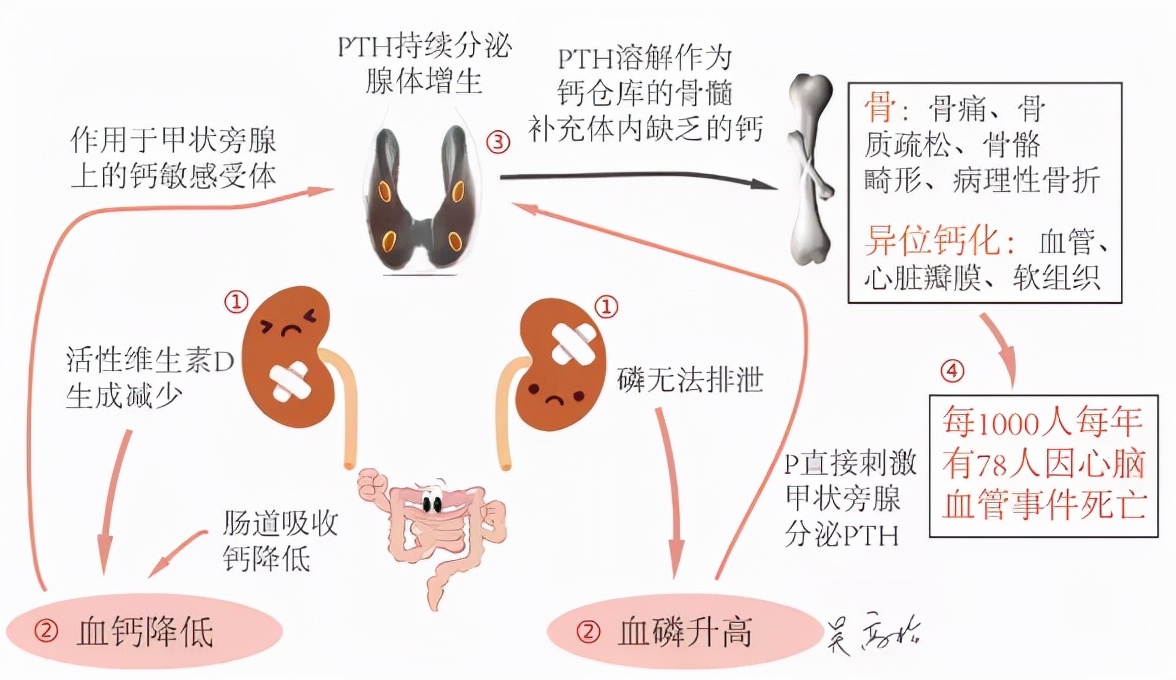 循证施治,解除大危害!唐山市人民医院内分泌科原发性甲状旁腺亢进症诊治病例分享
