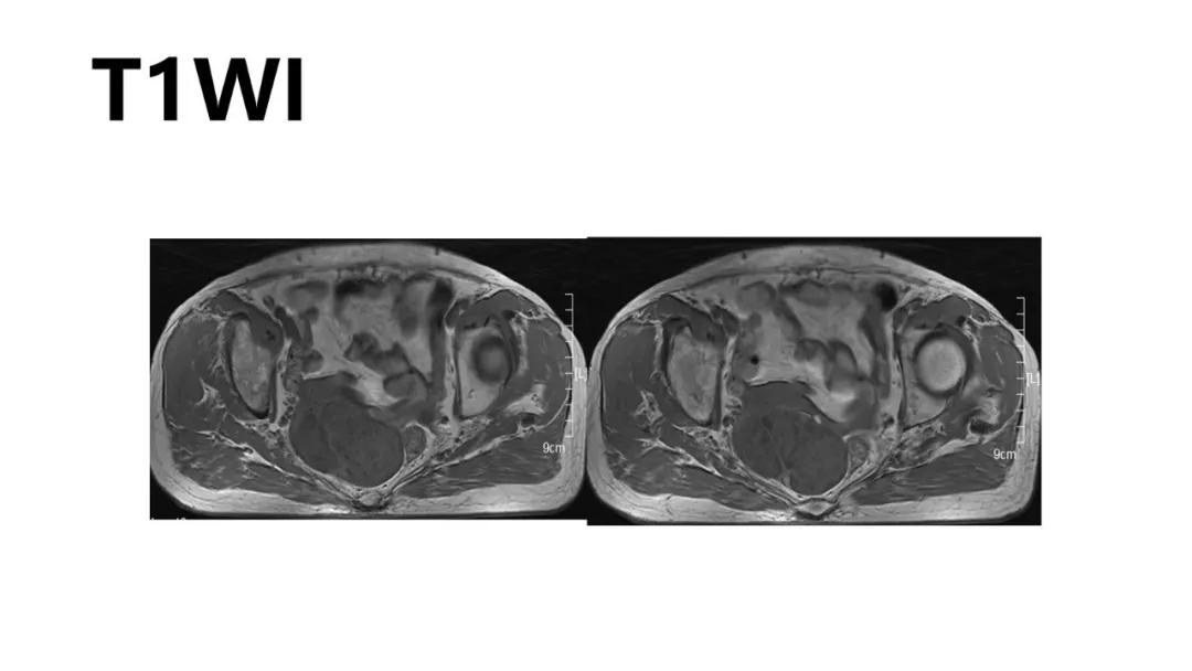 卵巢原发肿瘤的分析思路