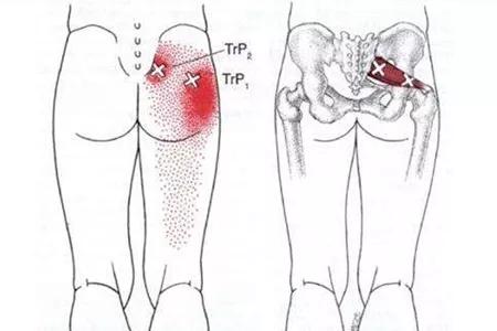 腰部脊椎疼是强直嘛,腰部强直是什么引起的