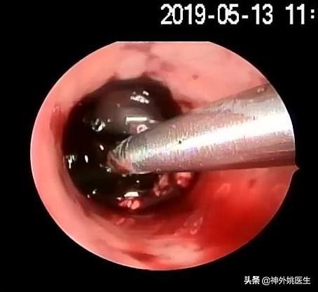 微创手术后血肿是什么,颅内血肿微创清除术多少钱