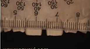 门牙缝可以补吗,门牙有缝怎么办如何补救