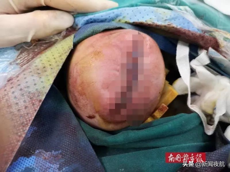 新生儿刚出生头顶侧面有个大包,宝宝一出生头上有个小包