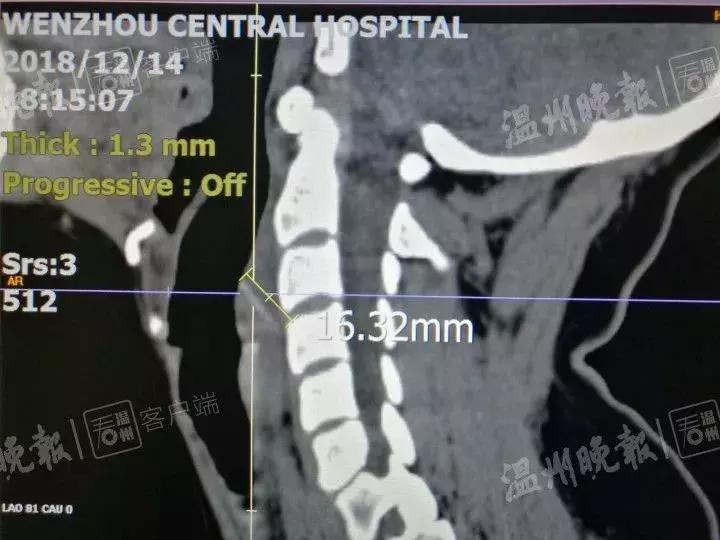 吃了烧烤喉咙剧痛,吃烧烤喉咙剧痛