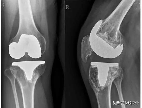 类风湿性关节炎手掌长有骨刺咋办,关节长骨刺一定是创伤性关节炎吗