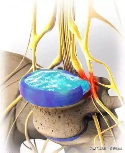 腰椎间盘突出神经根粘连能自愈吗,腰椎微创手术后神经根粘连怎么办
