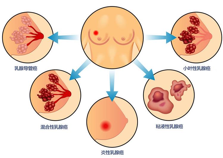 哺乳期乳房内长了一片小疙瘩,喂奶发现乳房有一个滚动的疙瘩