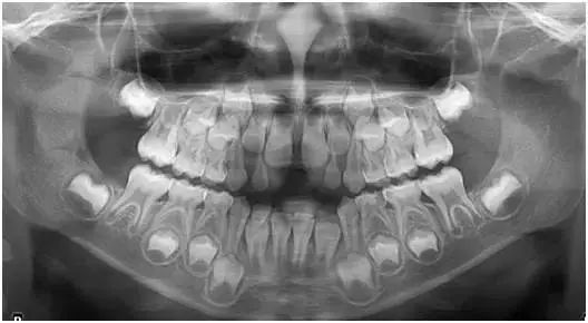 小孩拍牙齿片有危害吗,拍牙片对孩子的影响