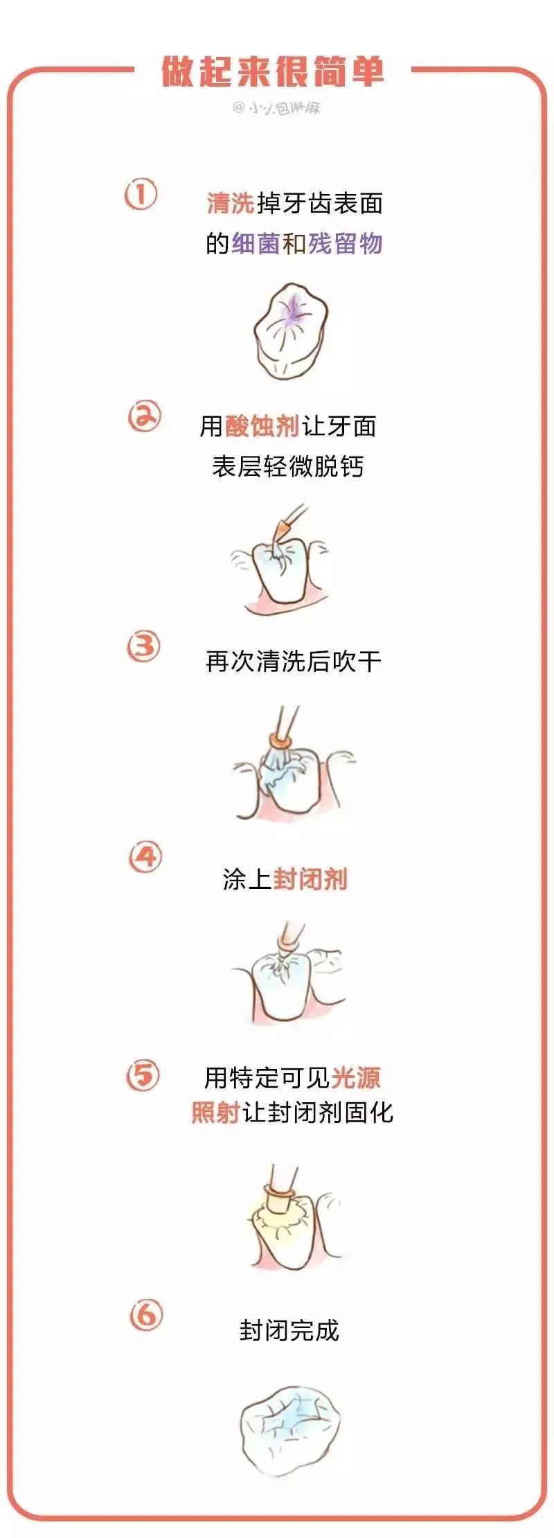 有蛀牙的孩子有必要做窝沟封闭吗,窝沟封闭能防蛀牙