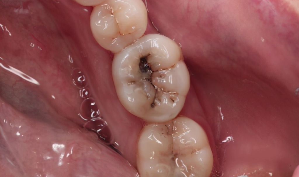 窝沟封闭预防儿童蛀牙的好方法,儿童窝沟封闭预防龋齿有什么危险