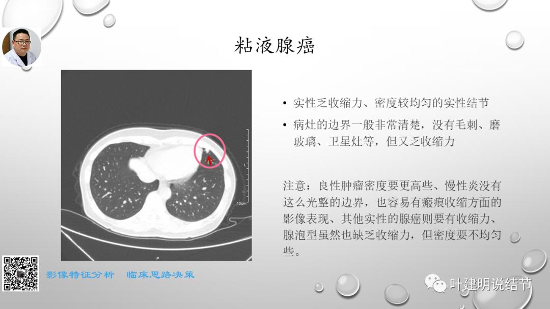 叶建明谈肺实性小结节视频,廖正银教授谈肺结节