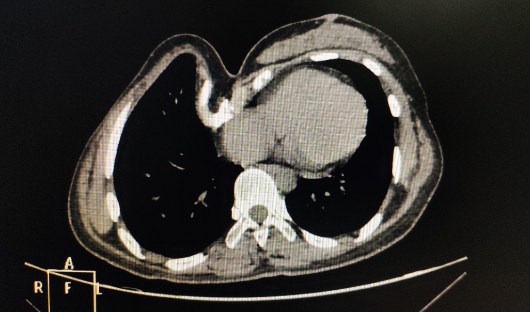 胸廓畸形矫正术后恢复,再创奇迹