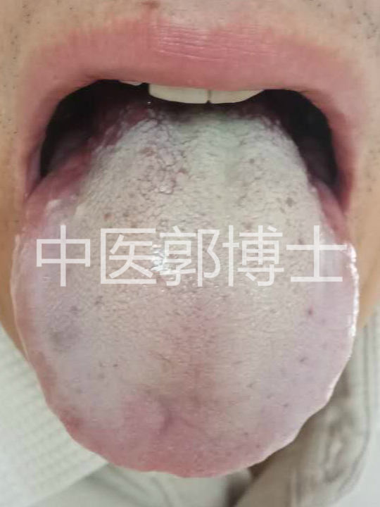 抑郁症吃中药后十天反而更严重了,抑郁症中药治疗几天见效果