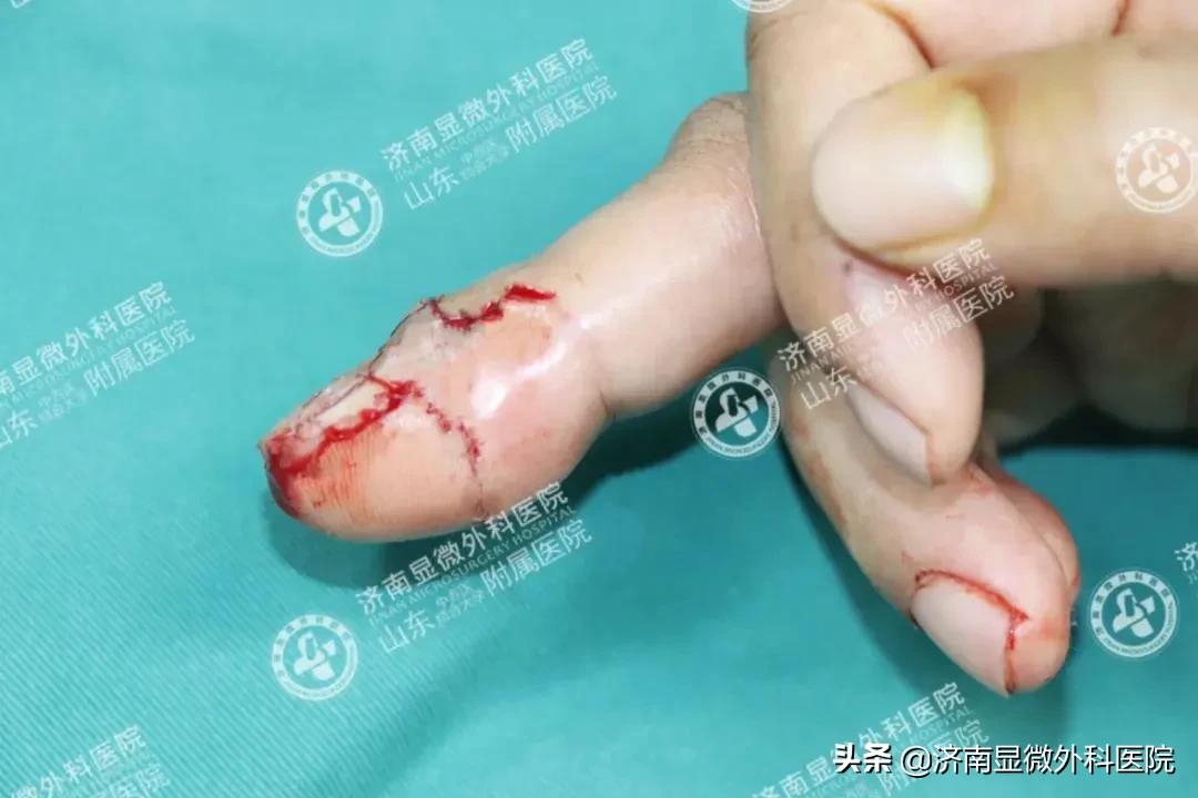 注意！失去一截手指不要灰心，这样做能重新复原它