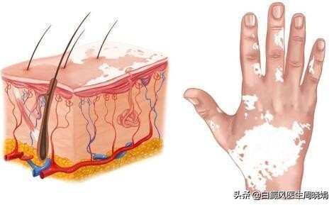 吃什么中药可以治愈白癜风,眼角白癜风擦什么药好