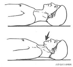 躺床头前倾矫正,怎么纠正头前倾