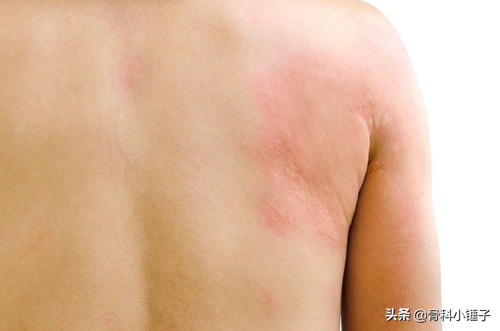 麻疹治疗主要措施,麻疹治疗方案