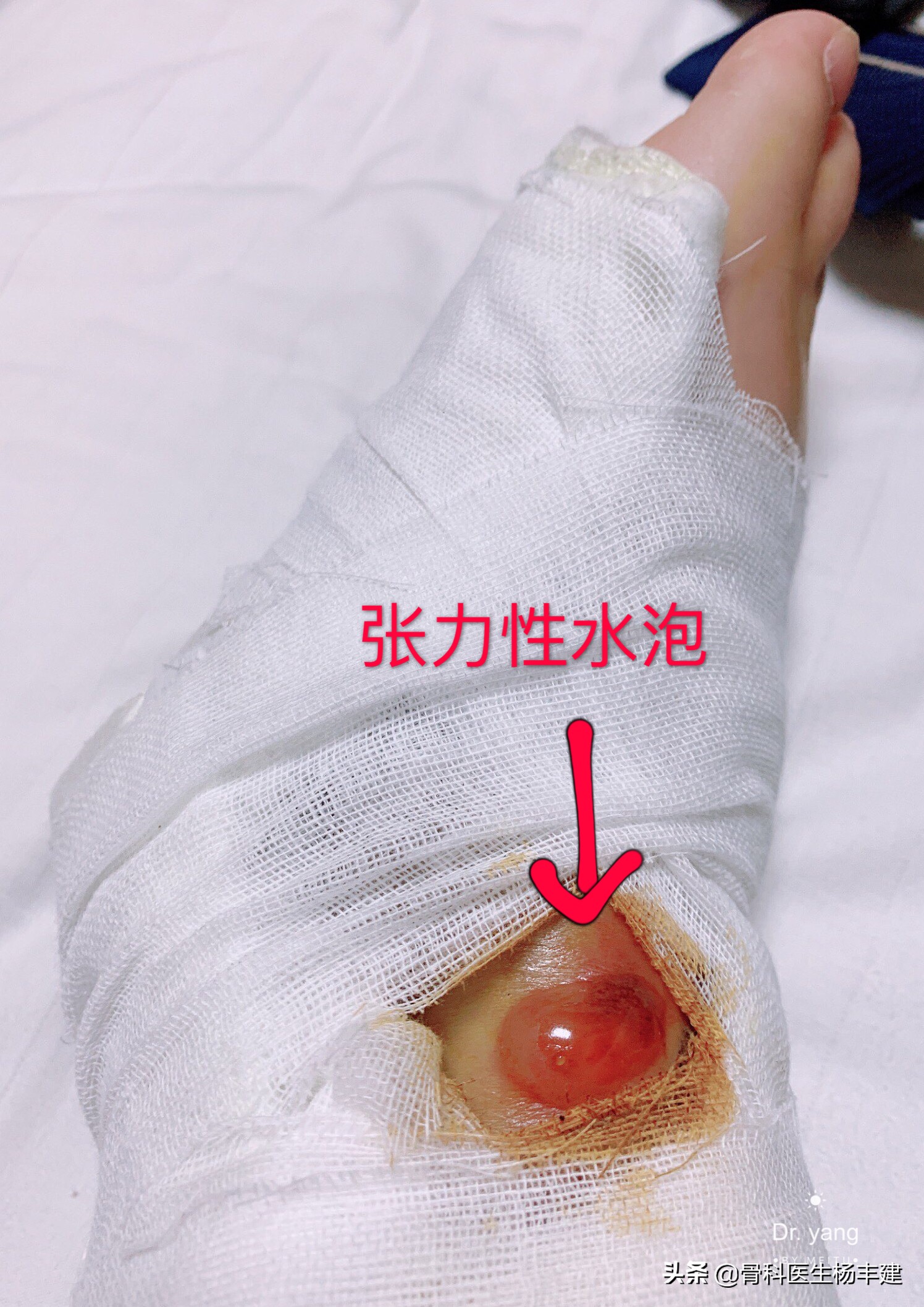 脚踝骨折做手术大概多少钱,右脚踝骨折做手术要多少小时