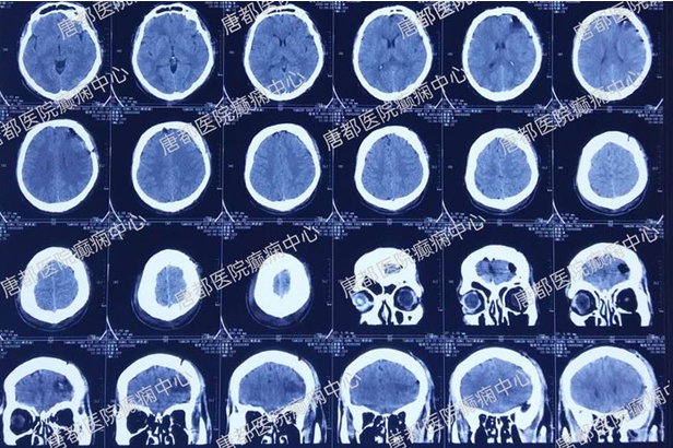 颞叶海绵状血管瘤癫痫微创手术,唐都医院脑肿瘤微创手术