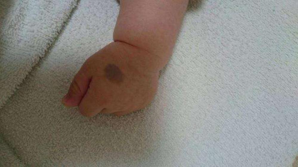 新生儿手臂上有淤青是什么原因,宝宝身上多了淤青什么引起的