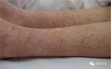 中医治过敏最好方法,中医告诉你过敏本质及治愈办法