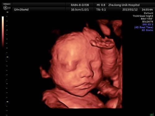 孕妇四维彩超要不要做,孕妇四维彩超有必要做吗