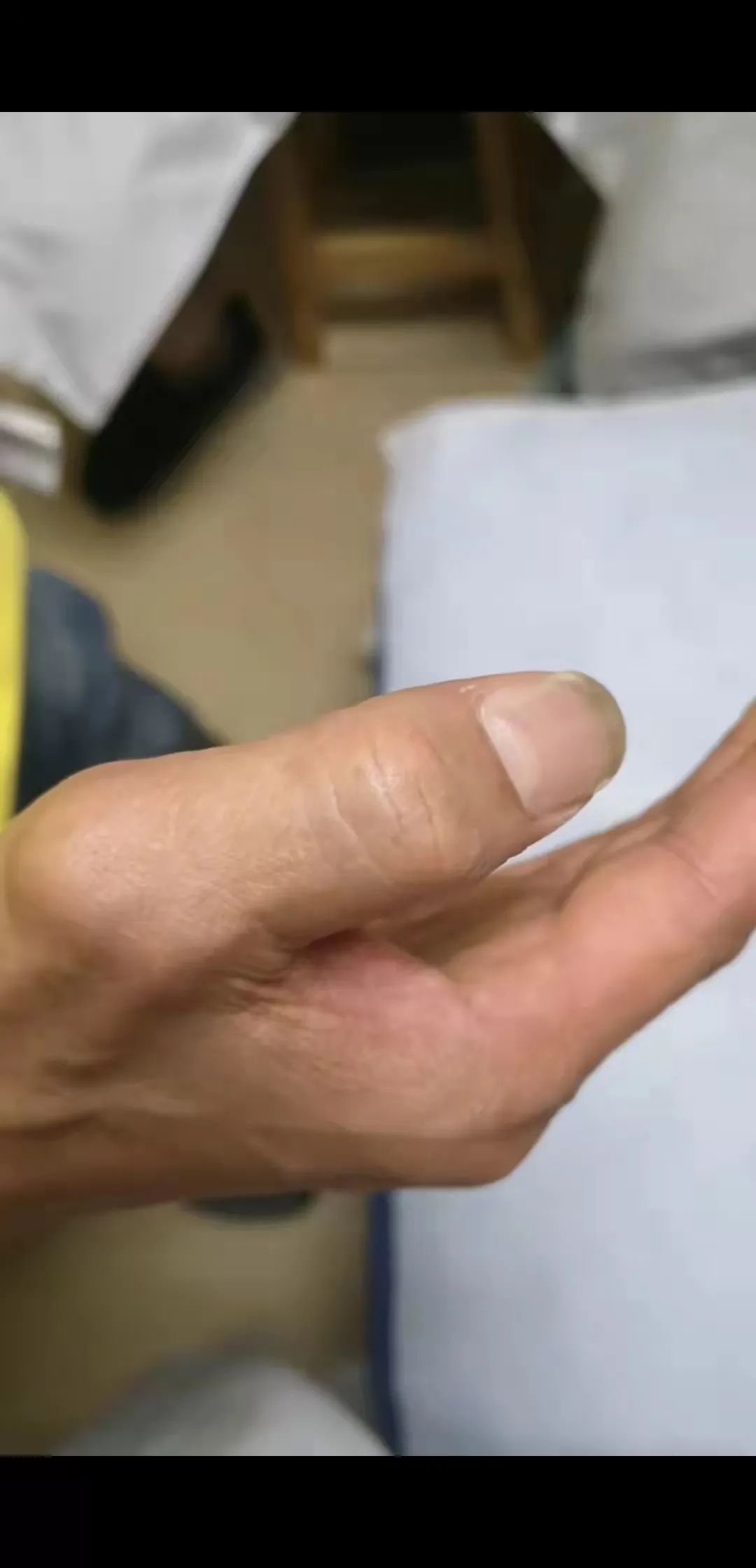 弹响指按摩哪个穴位能治,可视化小针刀松解视频