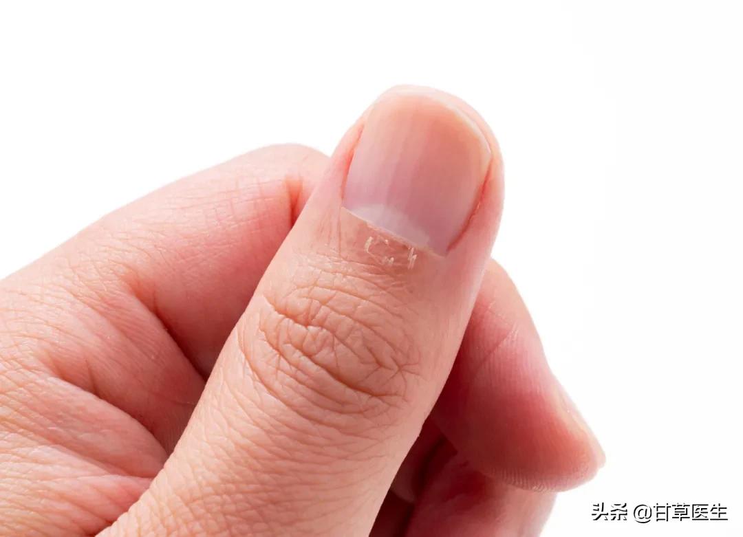 指甲的哪些变化需警惕疾病风险,指甲上有竖条纹是哪些疾病的征兆